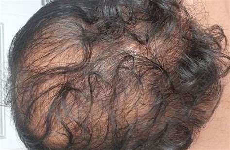 Hair Transplant On Diffuse Thinning Scalps Best Hair La