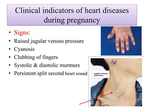 Heart Diseases During Pregnancy Ppt