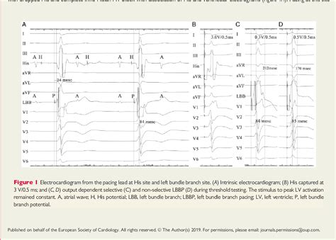 Figure 1 From Peri Left Bundle Branch Pacing In A Patient With Right Ventricular Pacing Induced