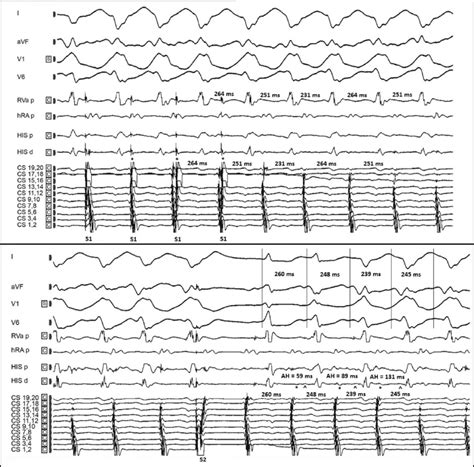 Induction Of A Wide Complex Tachycardia With Atrial Burst Pacing S1 Download Scientific