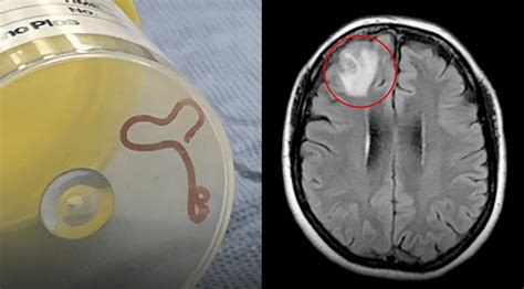 Barlaman Today - Live Worm Found in Woman’s Brain, Removed Successfully