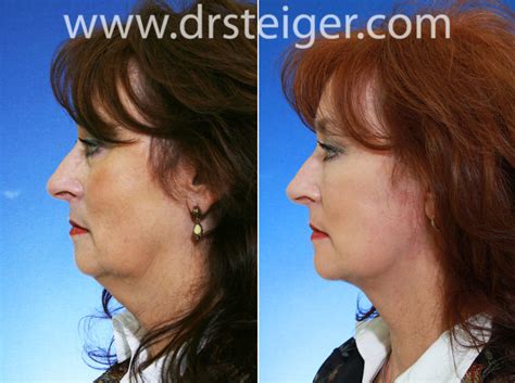 Face And Neck Lift Photos Steiger Facial Plastic Surgery Boca Raton