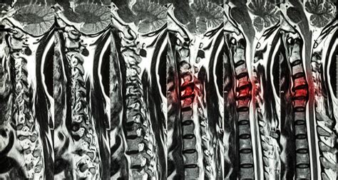 Cervical spondylosis with disc herniation ( MRI of cervical spine ...