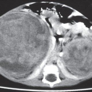 Contrast Enhanced Axial Computed Tomography Scan Showing Bilateral