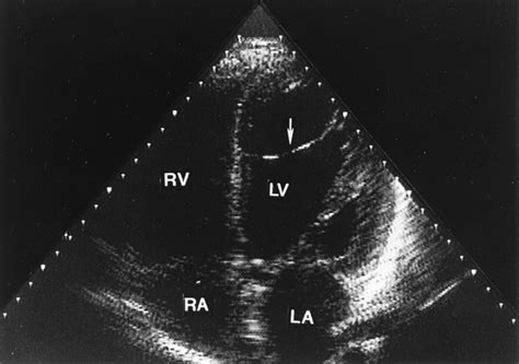 Anatomic Substrate For Idiopathic Left Ventricular Tachycardia