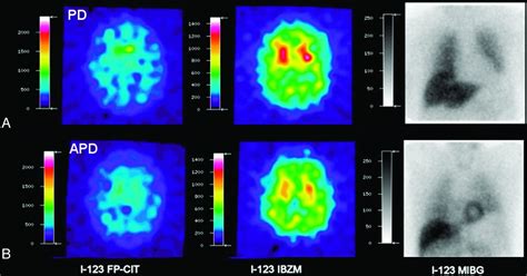 The Role Of Functional Dopamine Transporter Spect Imaging In