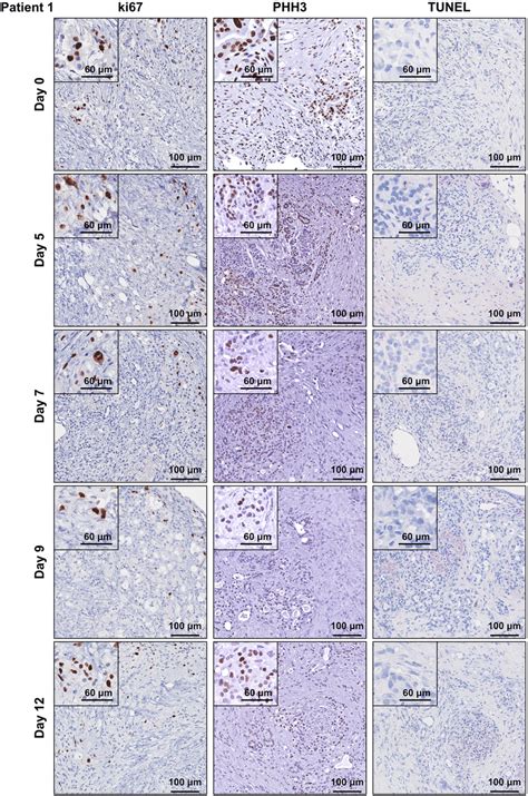 Human Patient Derived Pancreatic Ductal Adenocarcinoma Tumour Explants Download Scientific