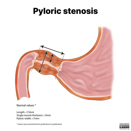 Pyloric stenosis | Radiology Reference Article | Radiopaedia.org