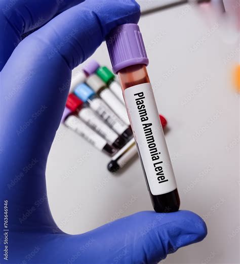 Blood sample for Ammonia test to diagnosis of ammonia levels also known as hyperammonemia. urea ...