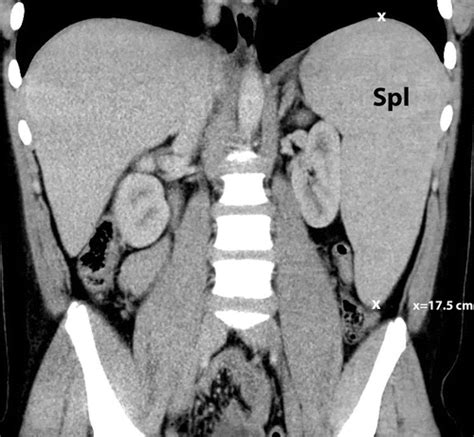 Manifestations Of Sickle Cell Disorder At Abdominal And Pelvic Imaging