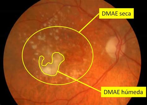 Entender la Degeneración Macular Asociada a la Edad DMAE en términos