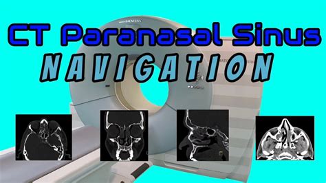 Ct Paranasal Sinus Navigation Youtube