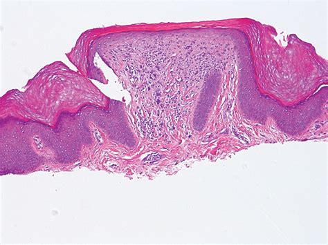 Acral Flesh Colored Papules On The Fingers Mdedge Dermatology