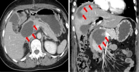 Pancreatic Fistula Following Extrahepatic Bile Duct Resection ...