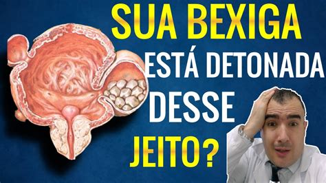 Sinais Que Sua Bexiga Est Detonada Por Causa Da Pr Stata Inchada Youtube