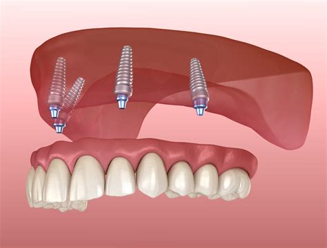 All On One Dental Implants Aurora Dentures Teeth Replacement