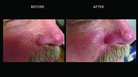 Rosacea Treatment Kelowna Facial Redness