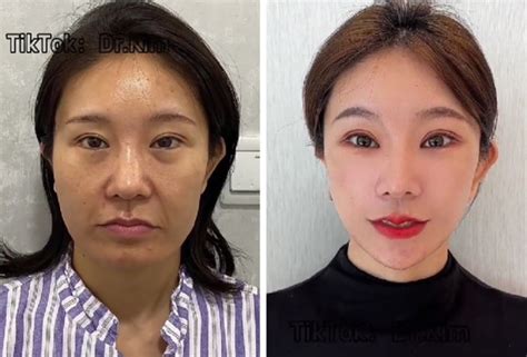 A Plastic Surgeon Goes Viral For His Transformation Videos Bright Side