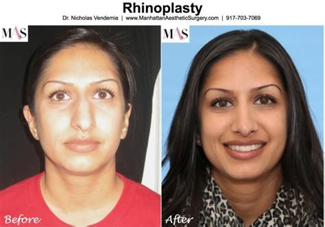 Cosmetic Plastic Surgery In New York City From Dr Vendemia Cosmetic