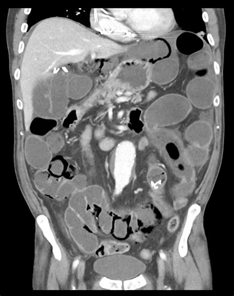 Rigler Sign And Pneumatosis Intestinalis Image