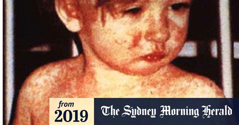 Video A Guide To Measles In Australia