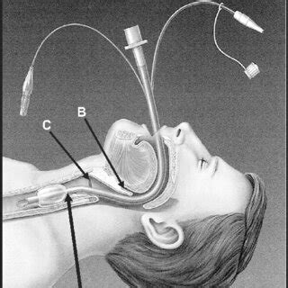 Hi Lo Evac Endotracheal Tube A Line For Aspiration Of Subglottic