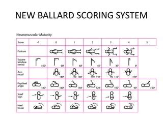 THE NEONATE NEW BALLARD SCORING SYSTEM .pptx | Free Download