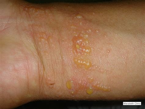 피부질환 백과사전﻿﻿ 173 옻피부염 Rhus Dermatitis 네이버 블로그