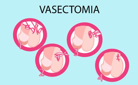 Procedimiento De Vasectom A Sin Bistur Dr Rodrigo Orozco Cirujano