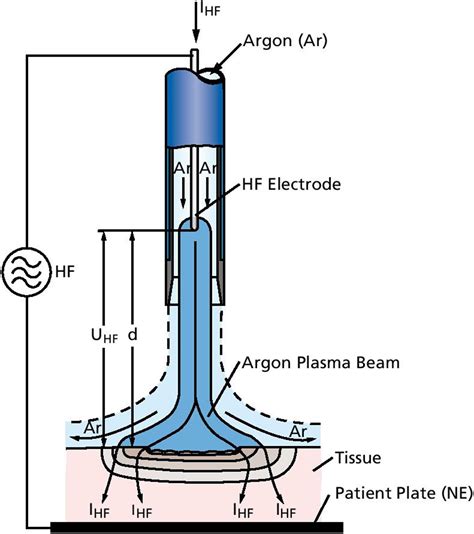 Argon Plasma Coagulation And Radiofrequency Ablation In Nonvariceal