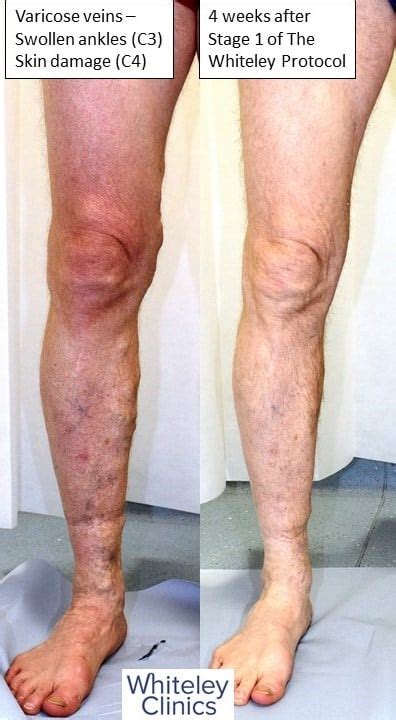 Huge Varicose Veins Treated With Endovenous Surgery