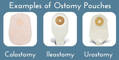 What Are The Different Types Of Colostomy Bags Sema Data Co Op