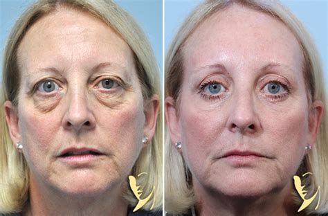 Brow Lift Lower Blepharoplasty Erbium Laser Resurfacing To Lower