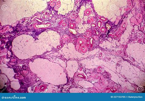 Ovarian Cyst Light Micrograph Photo Under Microscope Stock Image