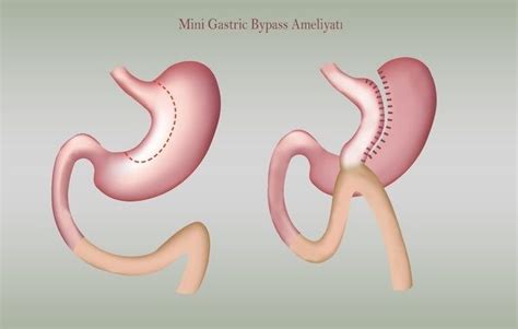 Mini Gastrik Bypass Ameliyatı Nedir Dr Necat Kaplan