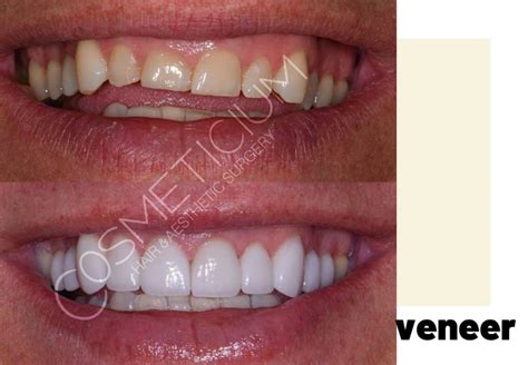 Veneers in Turkey: Affordable Cost Smile Makeover - Cosmeticium