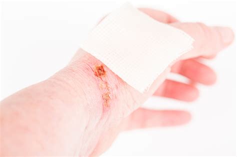 Chemical Burn On The Wrist Skin With Hydroxide Sodium Acid Household Accident Because Of Gloves