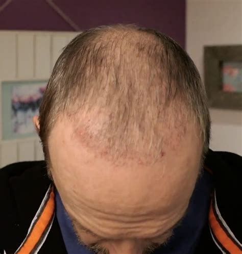 Hair Transplant After 2 Months Photos Results Side Effects