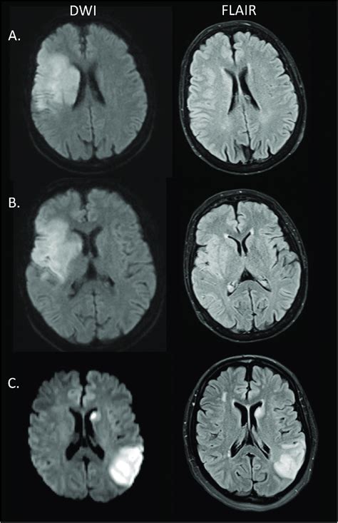 Exemplary Illustration Of Variable Amounts Of Flair Hyperintensity
