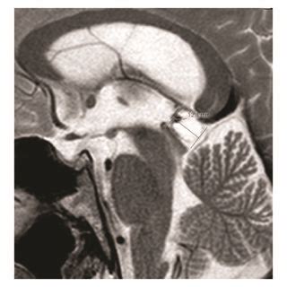 MRI of sella turcica at admission (August 2014): heterogeneous... | Download Scientific Diagram