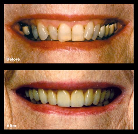 Crooked Teeth Treatment | Oppenheim Signature Smiles