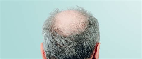 Hereditary Hair Loss Exploring The Causes Symptoms And Treatment Options