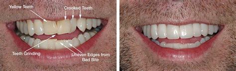 How To Straighten Teeth Without Braces Or Invisalign Invisalign Teeth