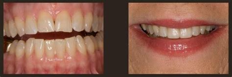 Cosmetic Dentistry Mace Dental Group Washington Mo 63090