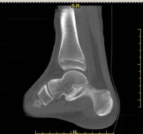 Technique Article Tarsal Coalition Resection Using Kirschner Wires