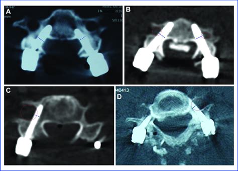 Cervical Pedicle Screws Cps Penetrations From Grade I To Grade Iii Download Scientific