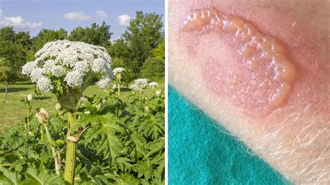 Now The Giant Hogweed Is In Bloom This Plant Burns The Skin 24 Hours