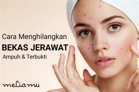 Cara Nak Hilangkan Jerawat Dan Bekas Jerawat Amyknoewalls