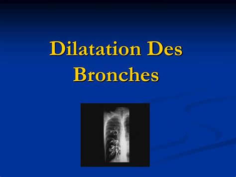 Ppt Dilatation Des Bronches Powerpoint Presentation Free Download