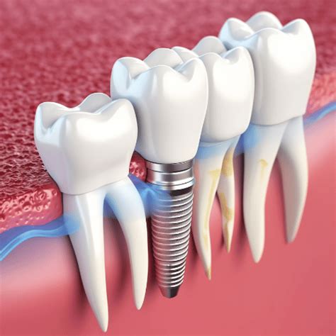 Full Mouth Dental Implants Lansdowne, Leesburg, Ashburn, Sterling, VA